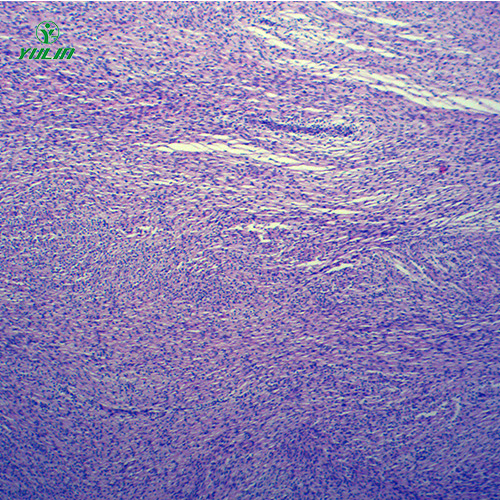 湖南人体肿瘤病理玻片